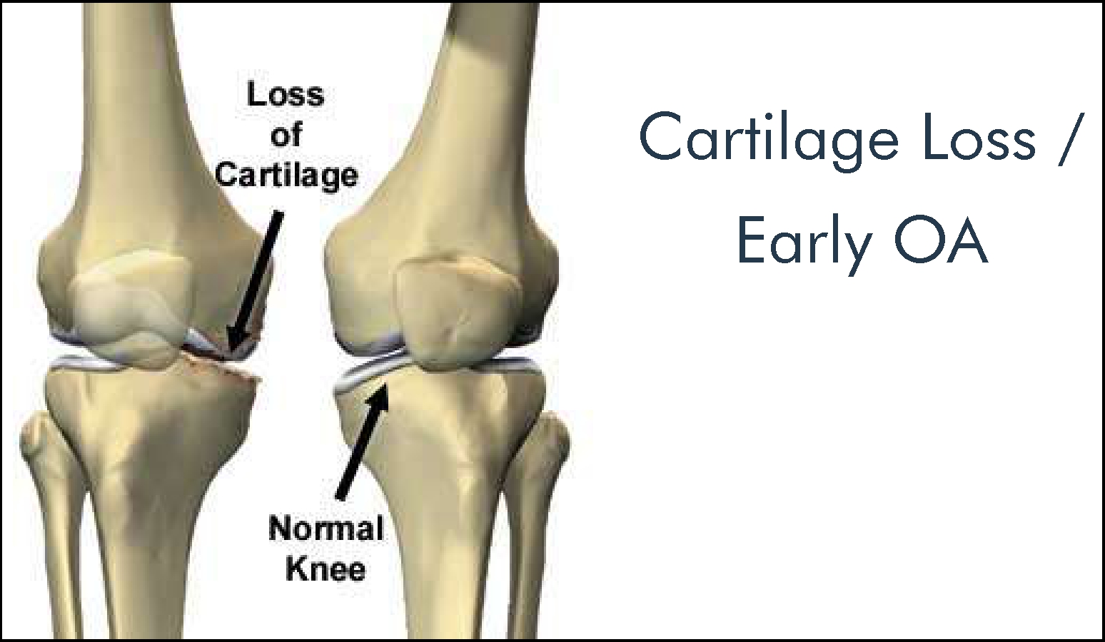 cartilage loss