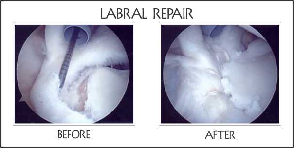 labral repair