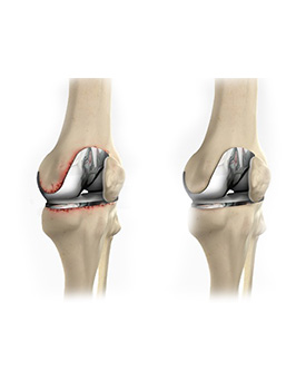 knee replacement surgeon