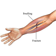 Hand Fracture